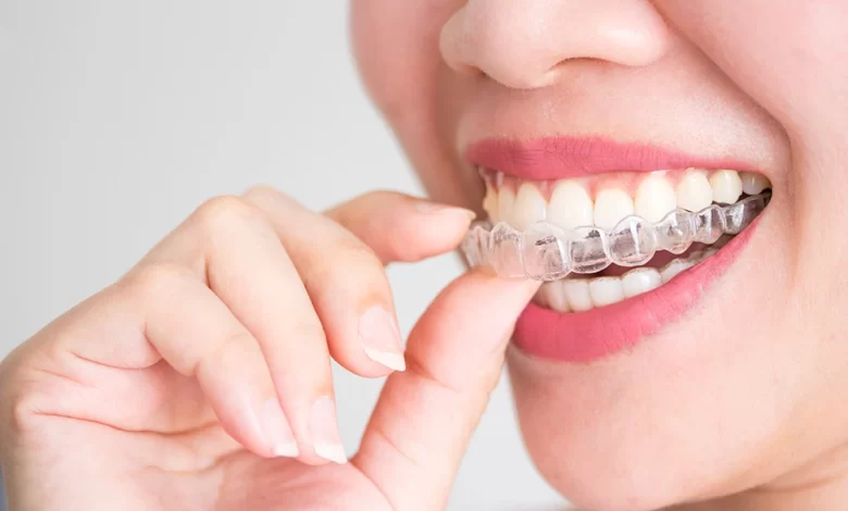 Invisalign in London Ontario