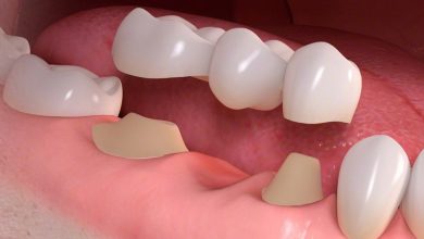 Photo of The Major Advantages And Disadvantages Of Dental Bridges