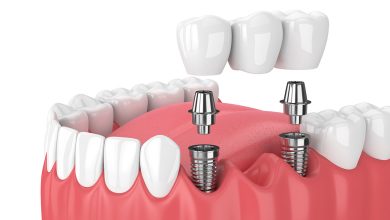 Photo of Dental Bridge: Restoring Your Smile And Dental Function